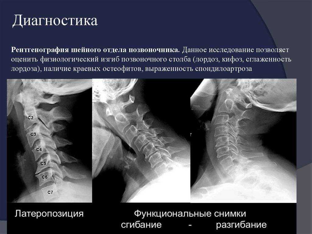 Функциональная нестабильность шейного отдела позвоночника: симптомы и лечение