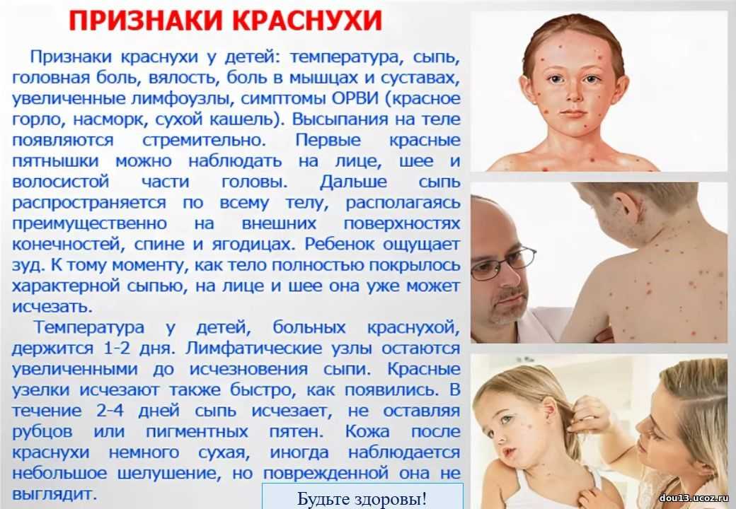 Скарлатина у детей в рязани, симптомы скарлатины